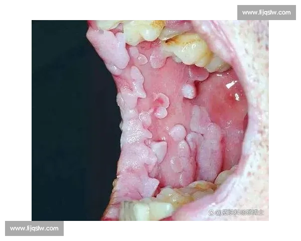 尖锐湿疣的早期症状、治疗方法及预防措施全面解析